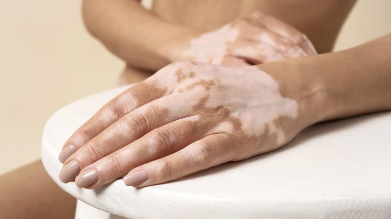 Vpliv osteoporoze na razvoj kožnih bolezni